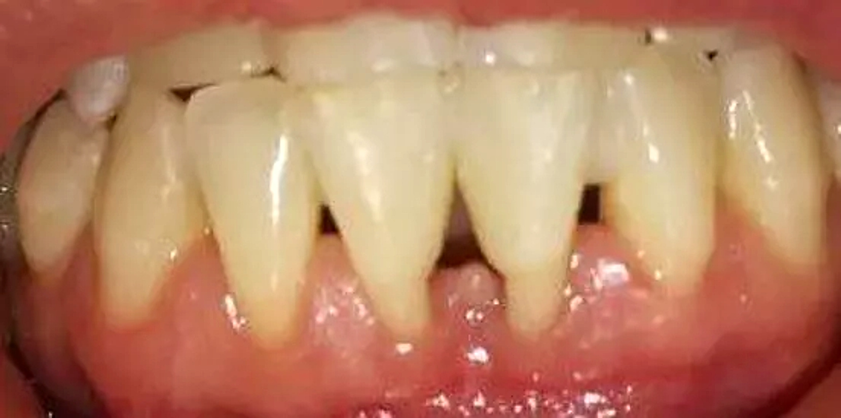 După tratamentul parodontal: țesut gingival sănătos și ferm