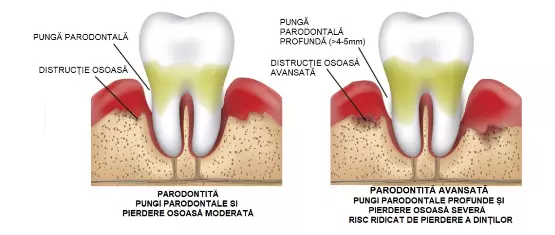 paradantoza2