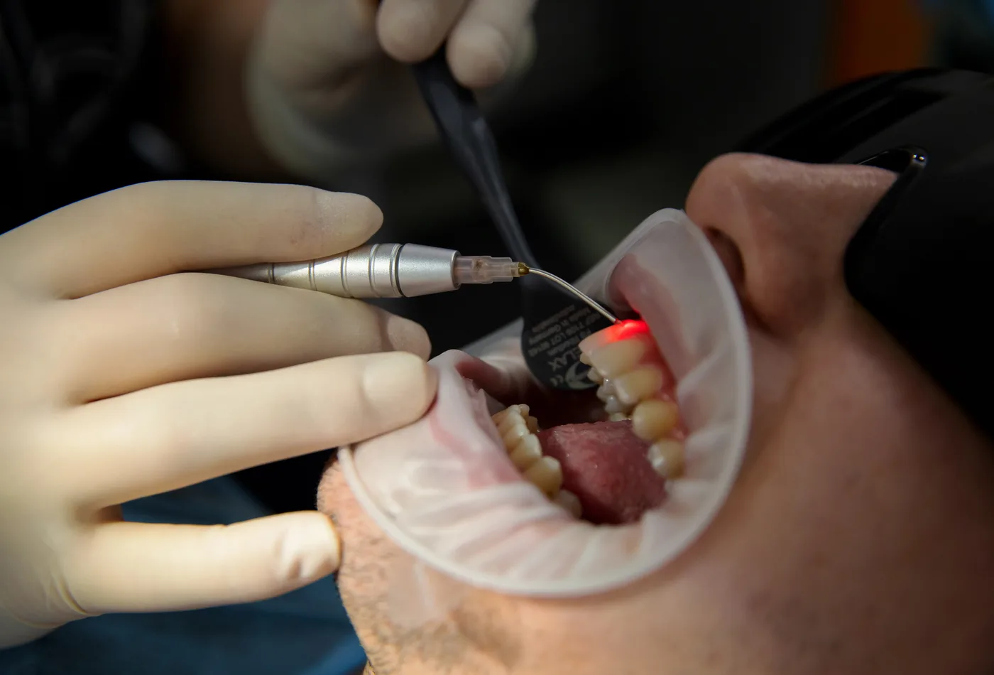 Tratament laser parodontal la Blue Dental Galați — fibră optică în gingie