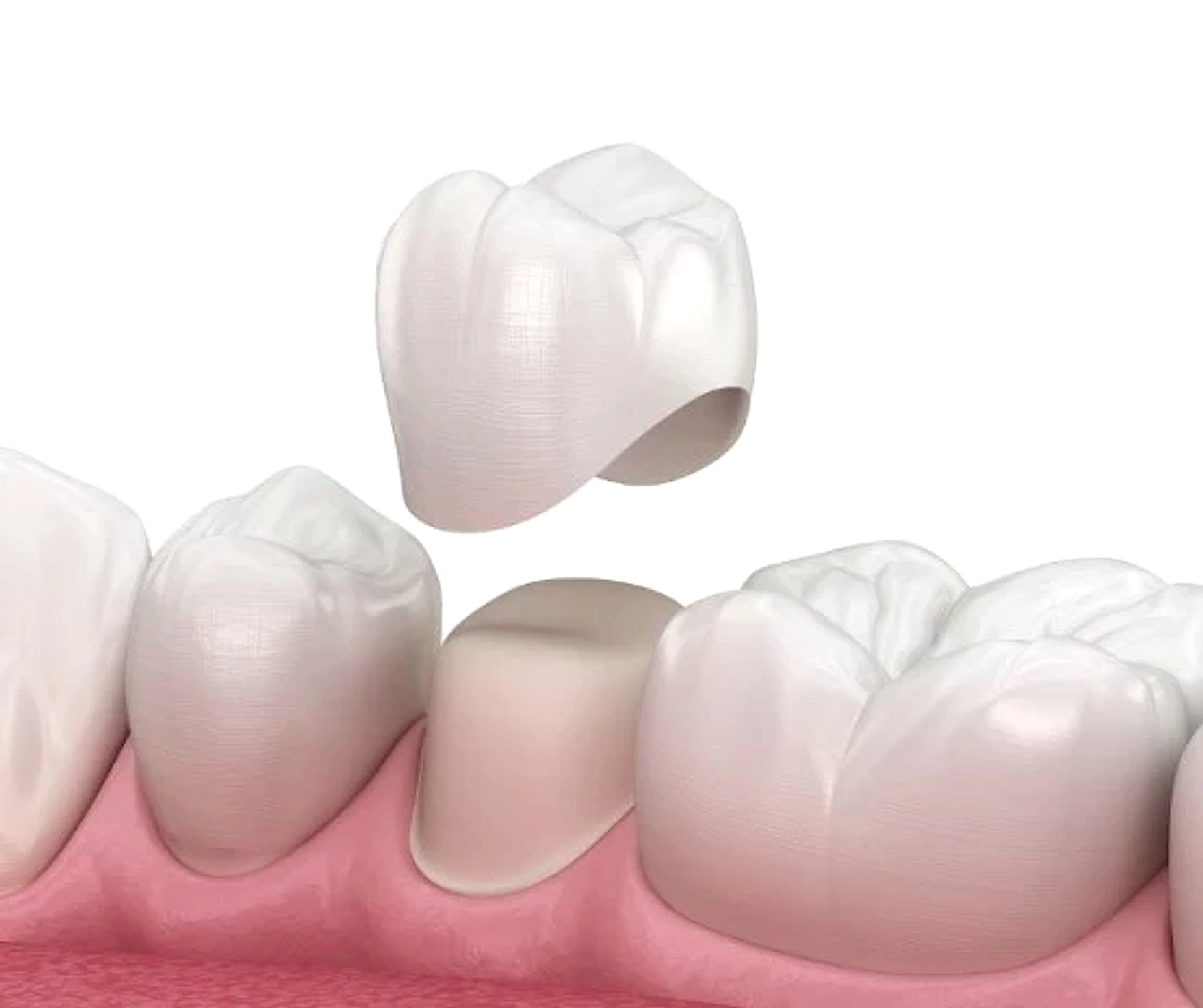 Restaurare protetică zirconiu Blue Dental Galați