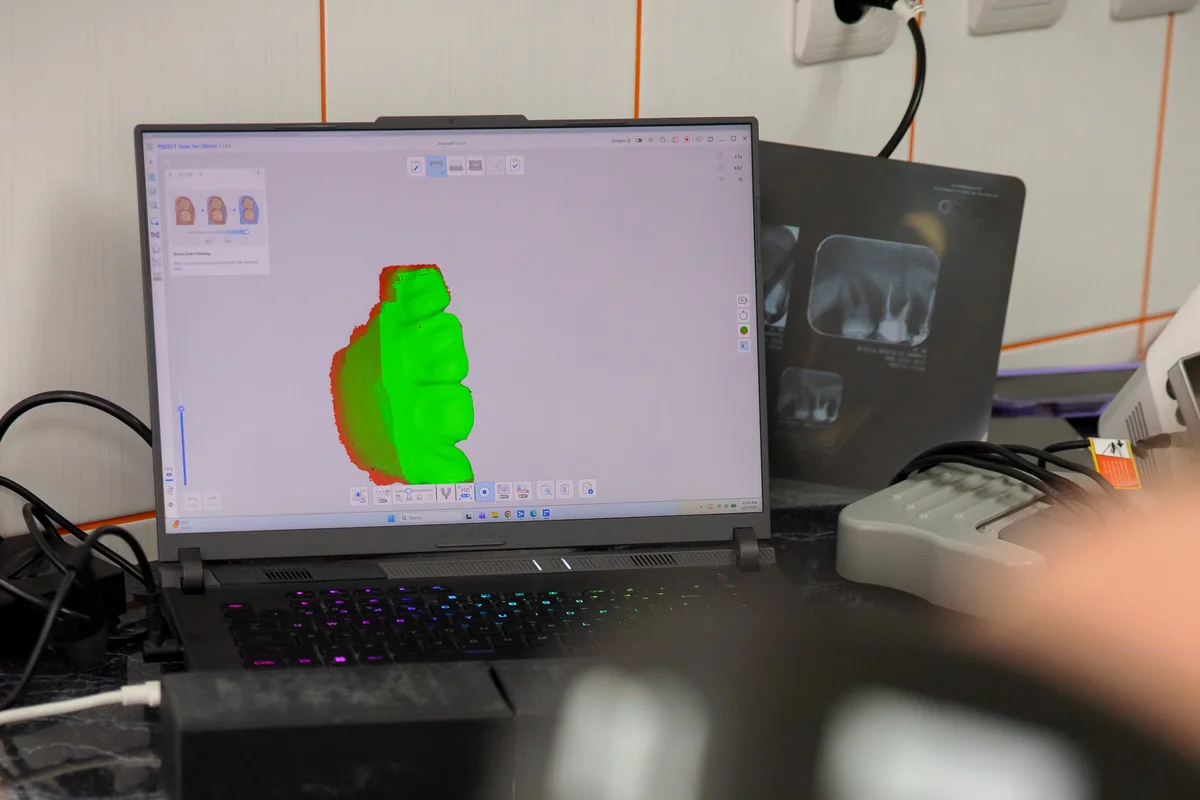 Scanner intraoral 3D și modelare digitală CAD/CAM pentru coroane și punți la Blue Dental Galați